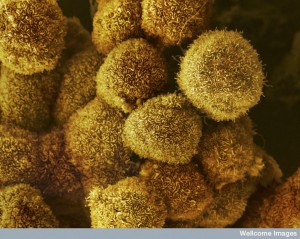 A cluster of pancreatic cancer cells. Scanning electron micrograph