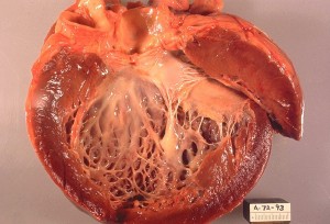 Gross pathology of idiopathic cardiomyopathy. Opened left ventricle of heart shows a thickened, dilated left ventricle with subendocardial fibrosis manifested as increased whiteness of endocardium. Autopsy.
