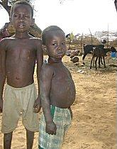 Niger_childhood_malnutrition_16oct06.jpg