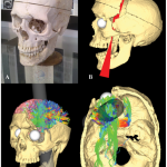 429px-Simulated_Connectivity_Damage_of_Phineas_Gage